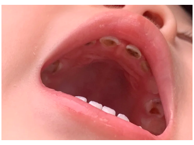 河北惟德口腔涂氟流程簡(jiǎn)單，孩子配合度拉滿