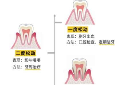 老年人牙齒松動(dòng)了要怎么辦？